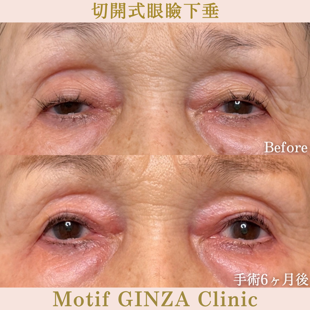切開式眼瞼下垂手術（手術6か月）の写真
