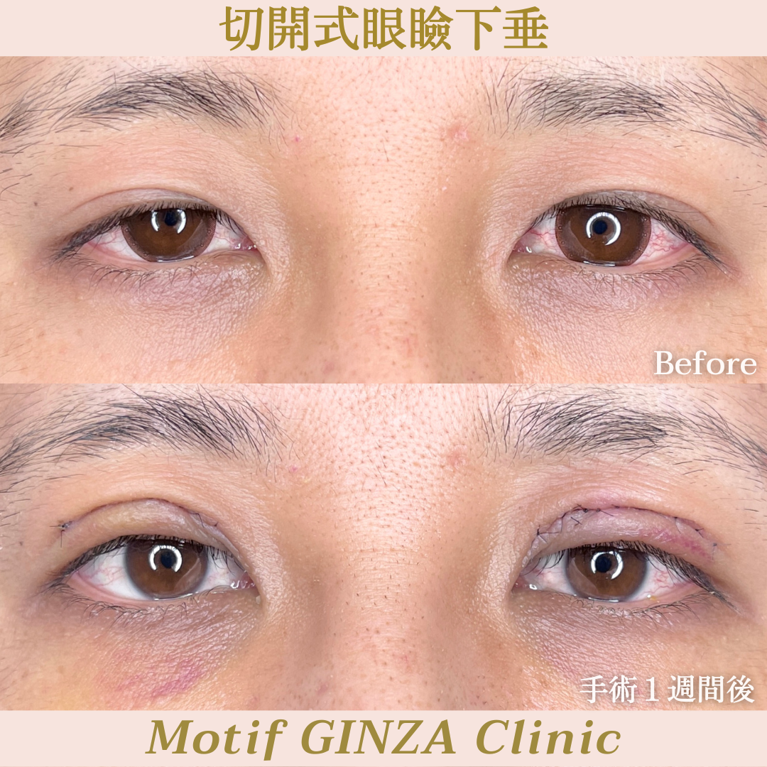 切開式眼瞼下垂手術（手術３ヶ月）の写真4