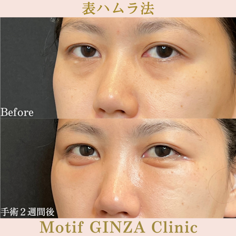 表ハムラ法（手術３か月）の写真6
