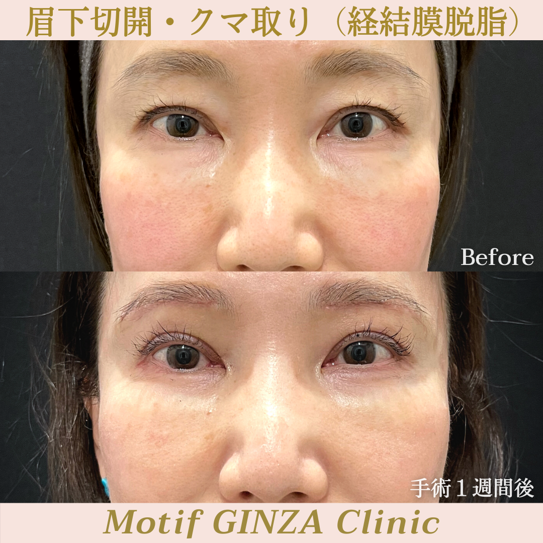 眉下切開・経結膜脱脂（手術７ヶ月）の写真5