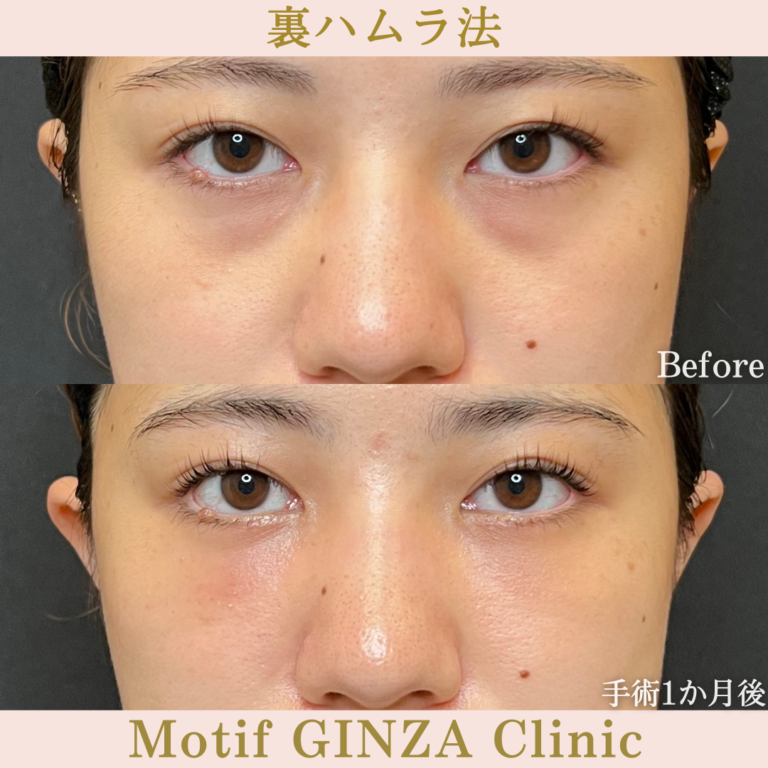 裏ハムラ法（手術３か月）の写真3