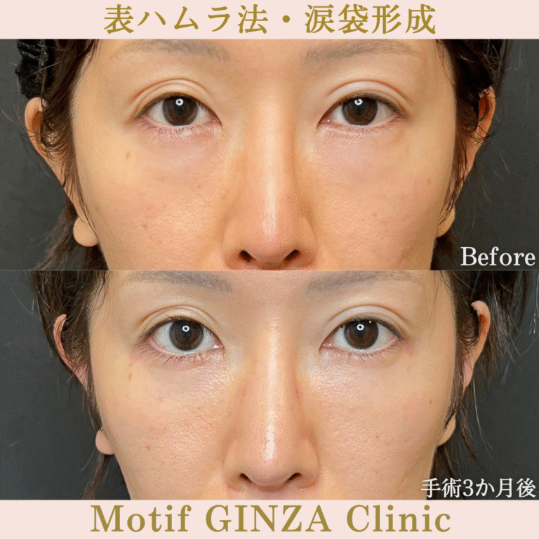 表ハムラ法・涙袋形成（手術３か月）