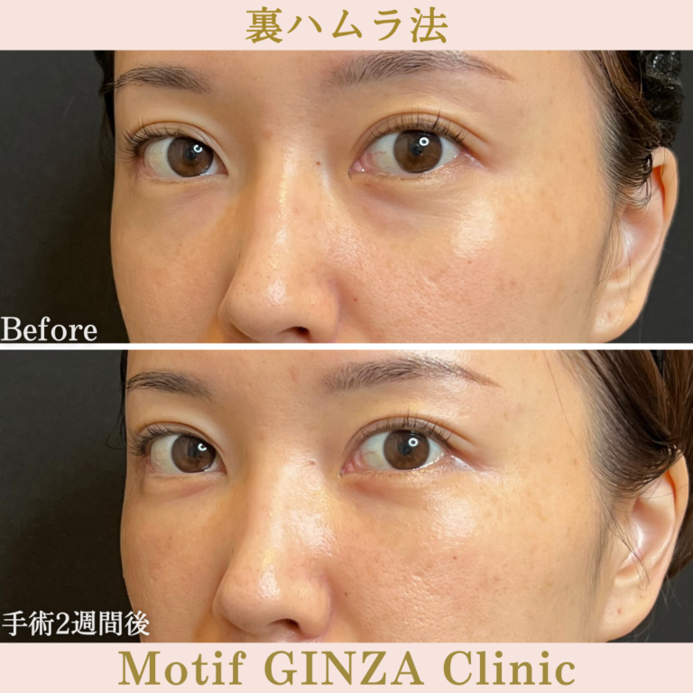 裏ハムラ法（手術3か月）の写真6
