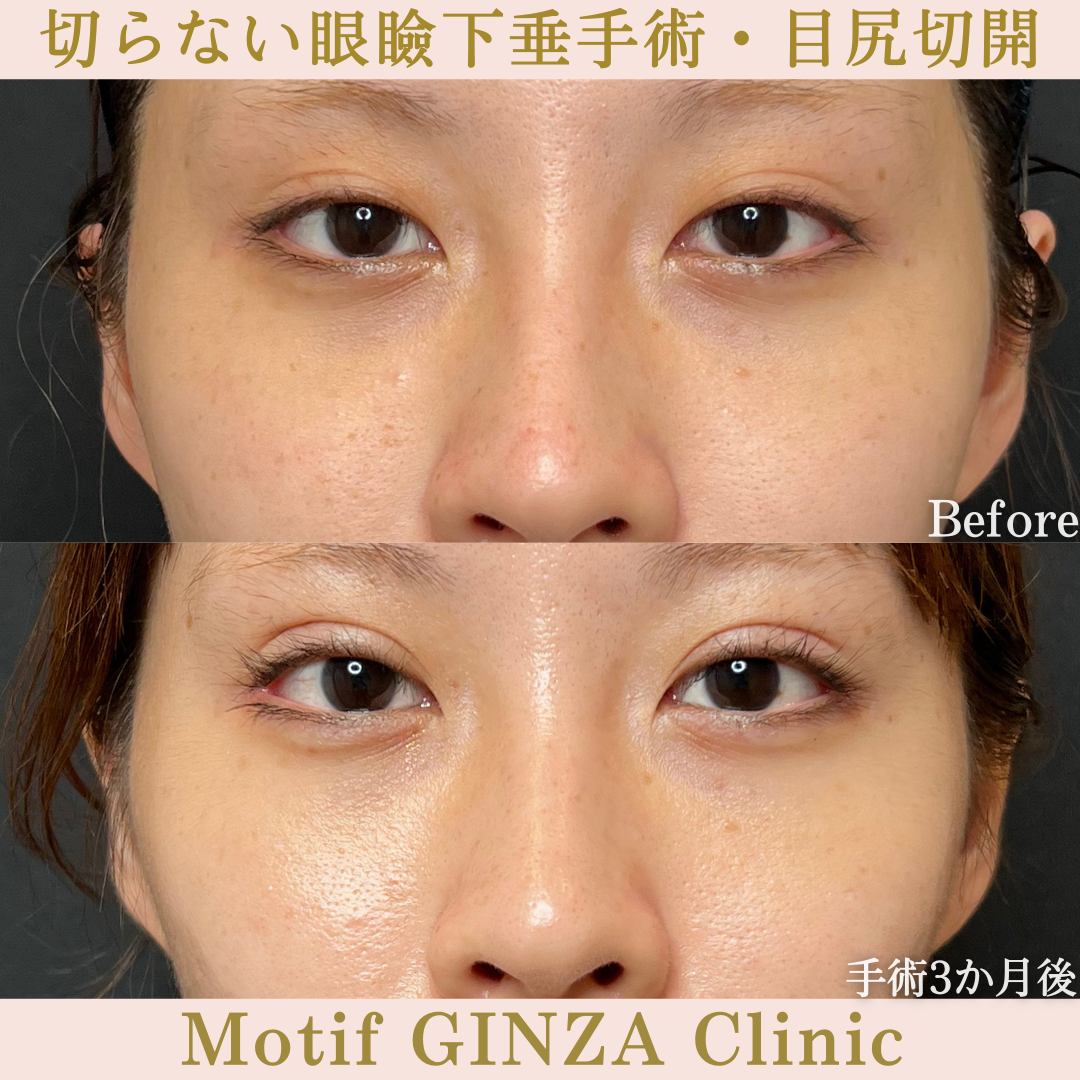 切らない眼瞼下垂手術・目尻切開（手術３か月）の写真
