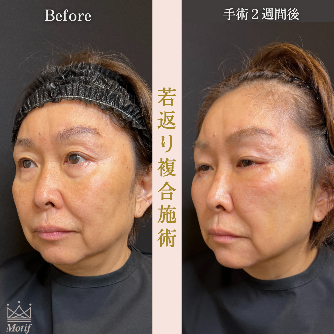 若返り複合施術（手術３ヶ月）の写真6