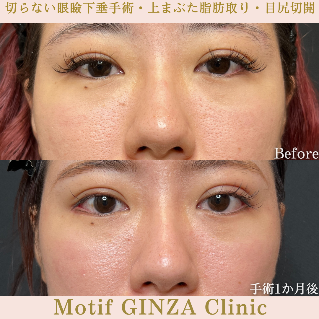 切らない眼瞼下垂手術・上まぶた脂肪取り・目尻切開（手術３か月）の写真2
