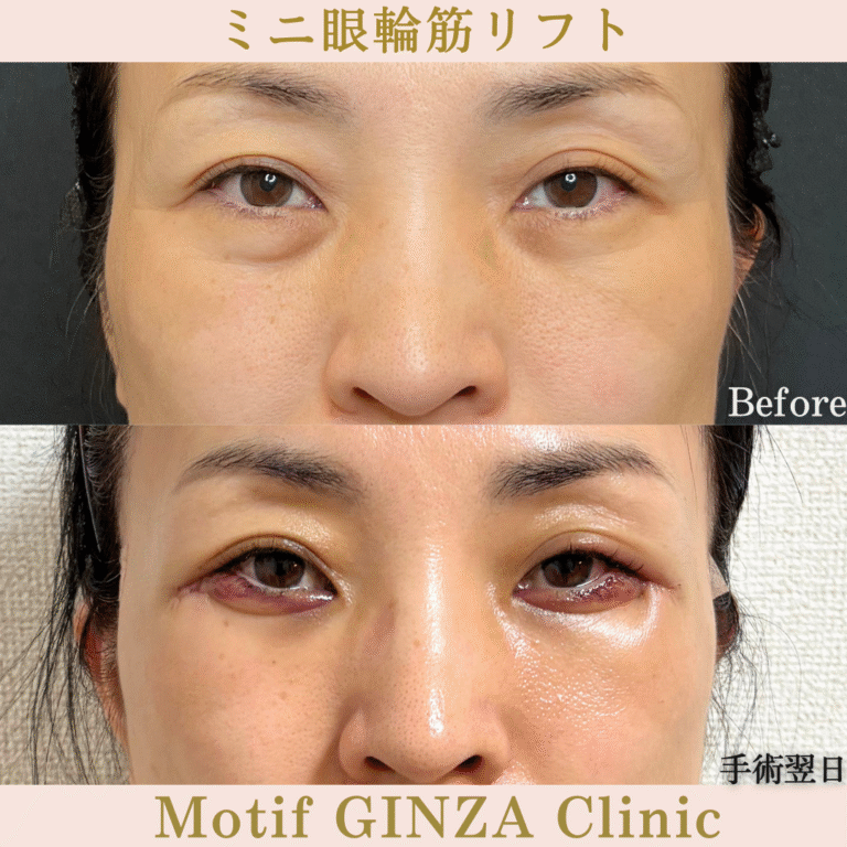 ミニ眼輪筋リフト（手術３か月）の写真5