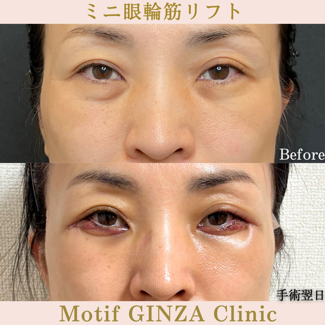 ミニ眼輪筋リフト（手術３か月）の写真5