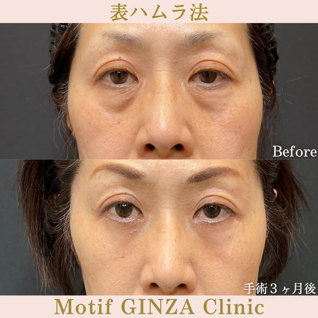 切開式下眼瞼たるみ取り（手術３ヶ月）の写真