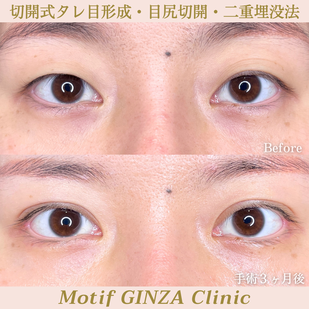タレ目形成・目尻切開・二重埋没法（手術３ヶ月）の写真