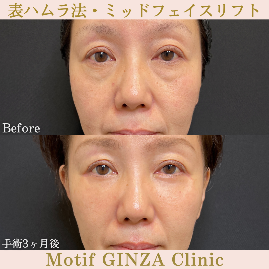 切開式下眼瞼たるみ取り・ミッドフェイスリフト（手術３ヶ月）の写真