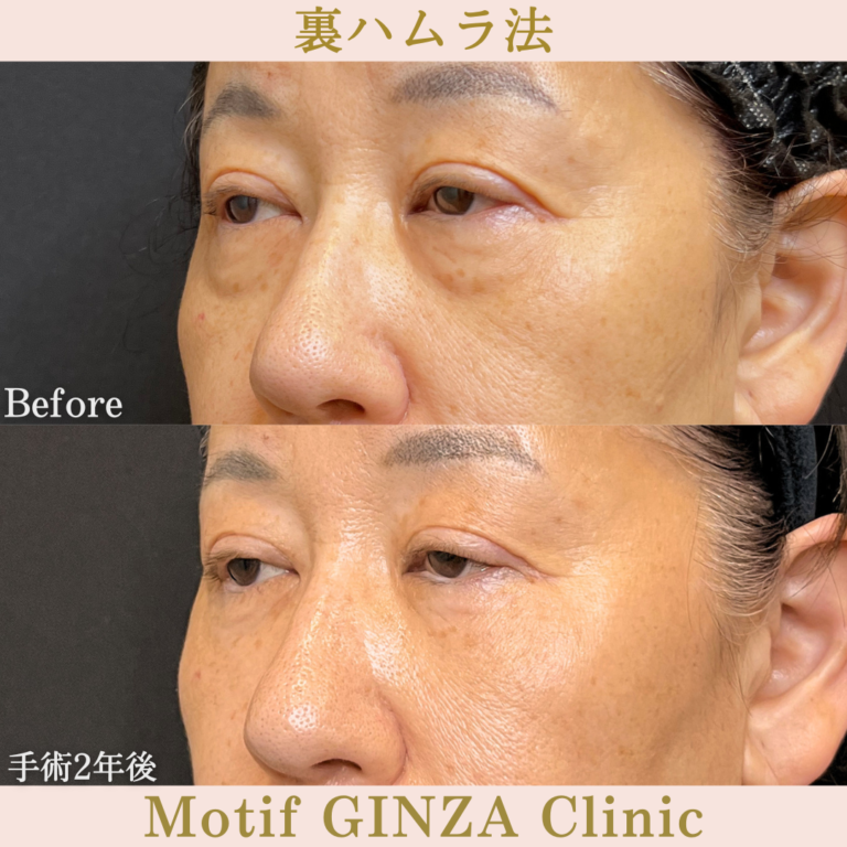裏ハムラ法(手術2年後)の写真2