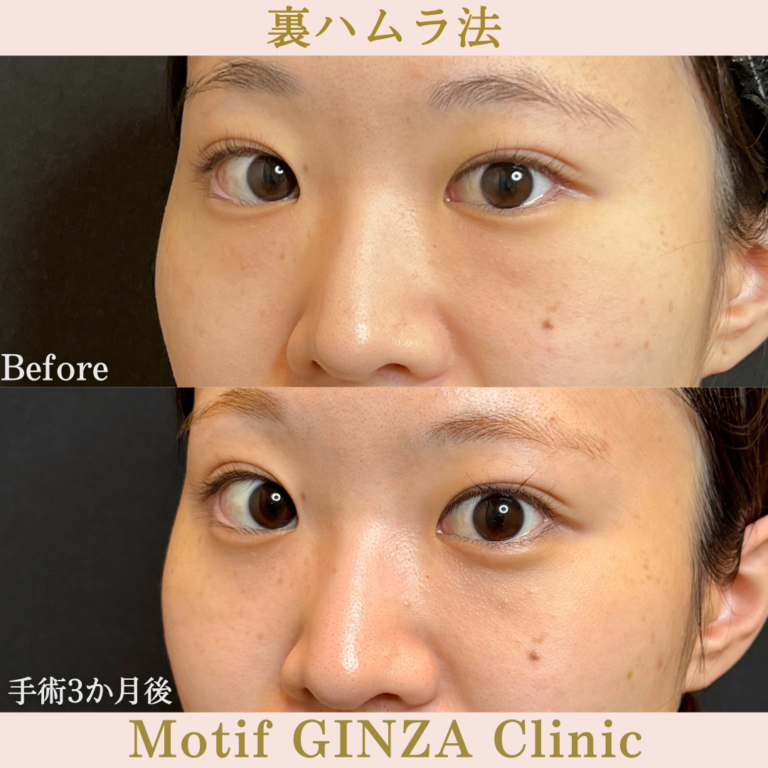 裏ハムラ法（手術3か月）の写真2