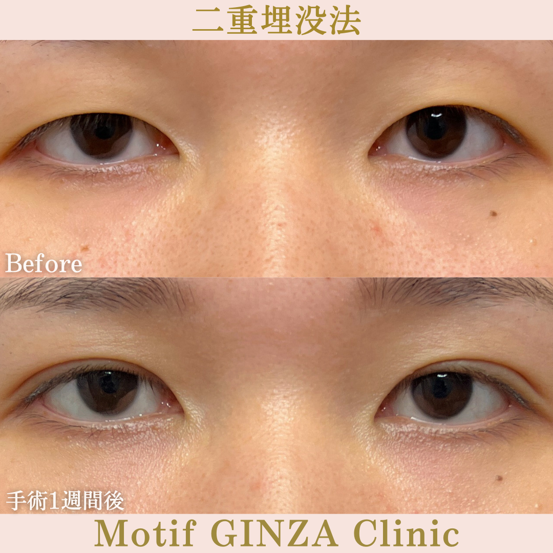 二重埋没法（手術１ヶ月）の写真2