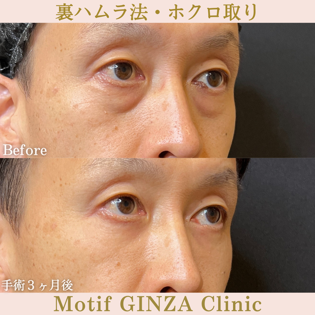 裏ハムラ法(手術6ヶ月)の写真4