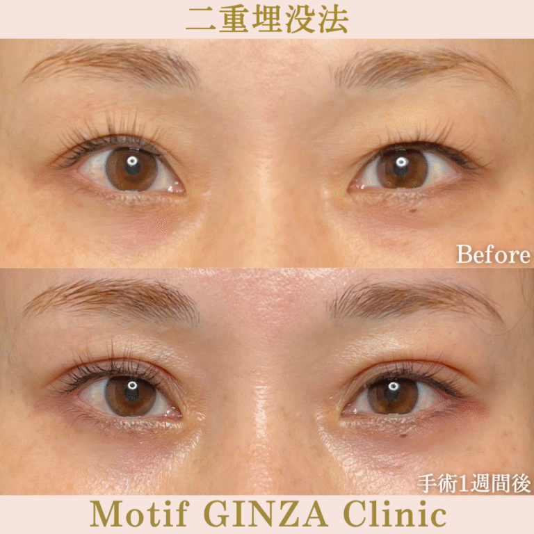 二重埋没法(手術1か月)の写真2