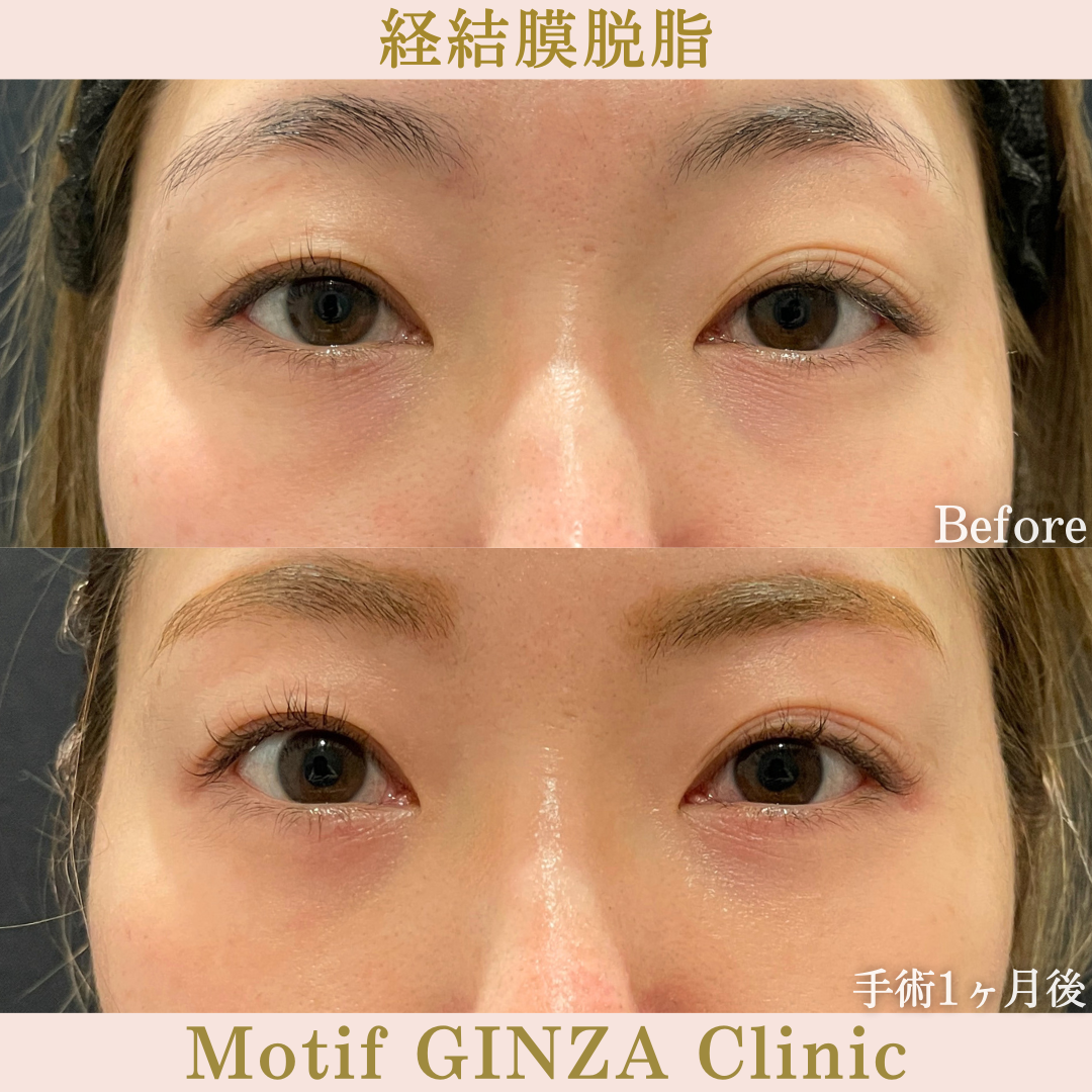 経結膜脱脂（手術１ヶ月）の写真