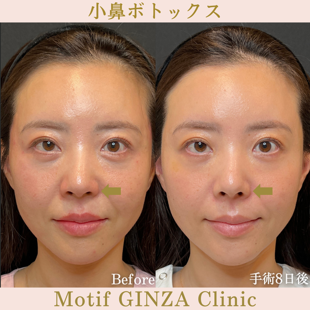 小鼻ボトックス（手術８日後）の写真