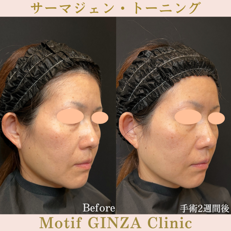 サーマジェン・トーニング(手術1か月)の写真4
