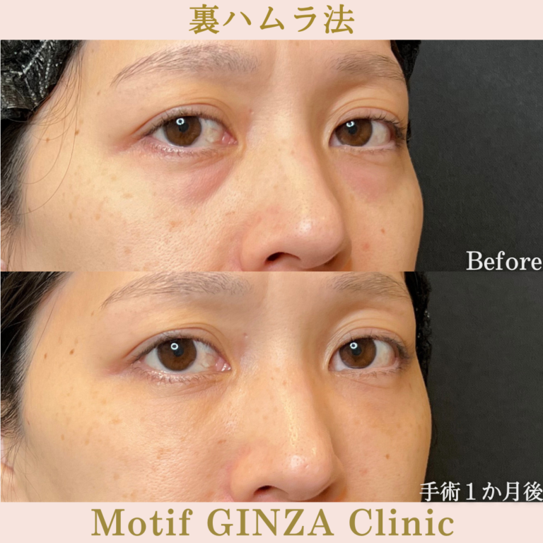 裏ハムラ法(手術1か月)の写真2