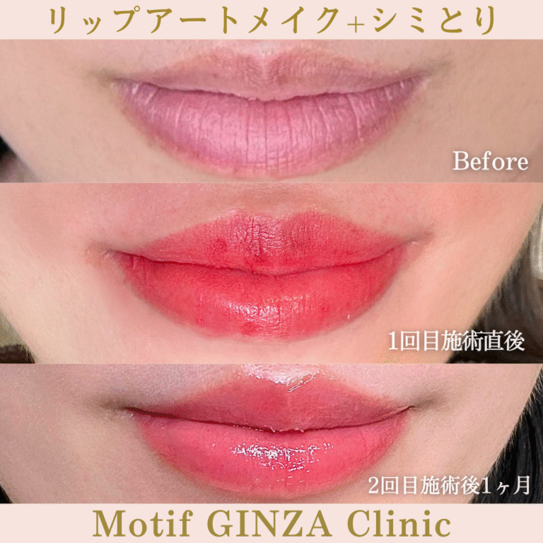 リップアートメイク・シミとり（施術１回目２か月）