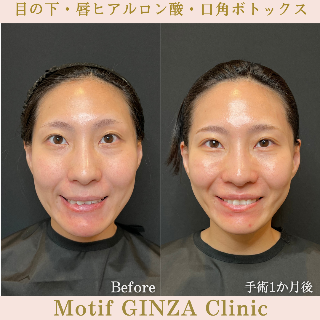 目の下・唇ヒアルロン酸・口角ボトックス（手術１か月）の写真
