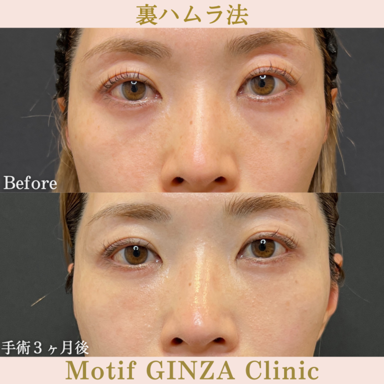 裏ハムラ法（手術2年３ヶ月）の写真3