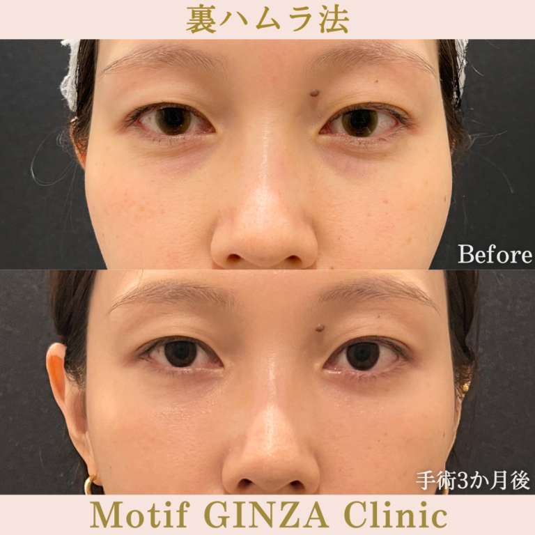 裏ハムラ法（手術３ヶ月）