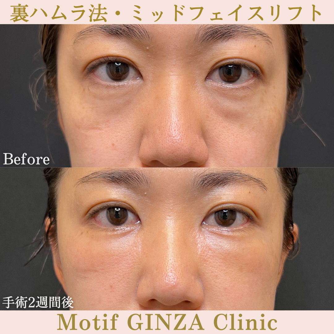 裏ハムラ法・ミッドフェイスリフト（手術１年１ヶ月）の写真5