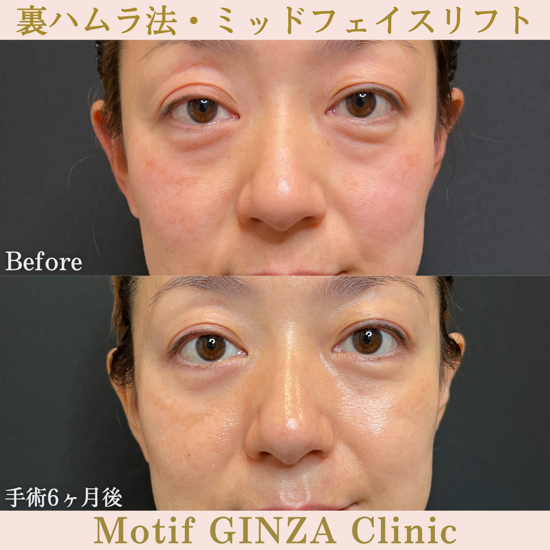 裏ハムラ法・ミッドフェイスリフト（手術６ヶ月）の写真