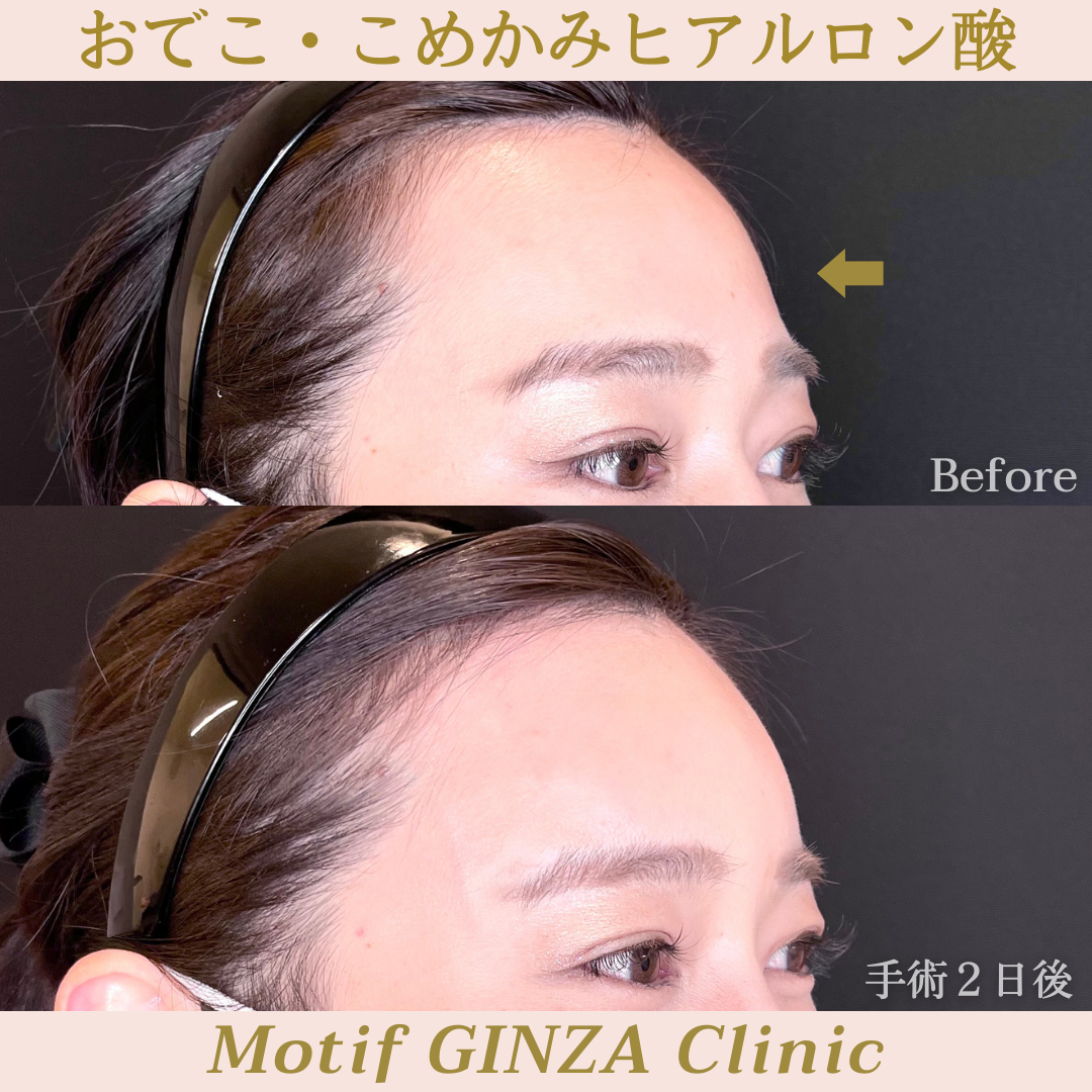額・こめかみヒアルロン酸(手術2日)の写真1