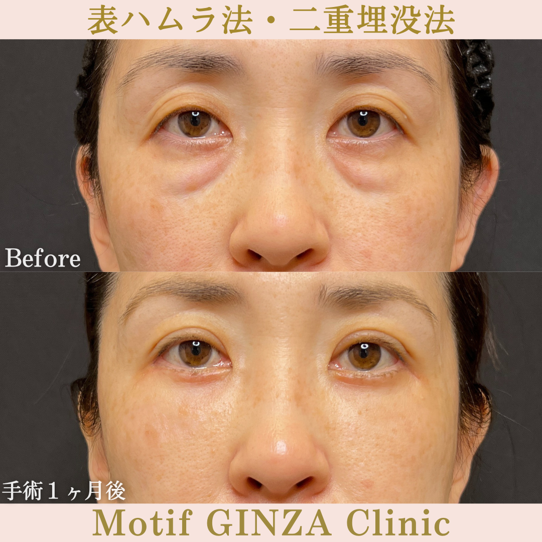 切開式下眼瞼たるみ取り・二重埋没法（手術６ヶ月）の写真3