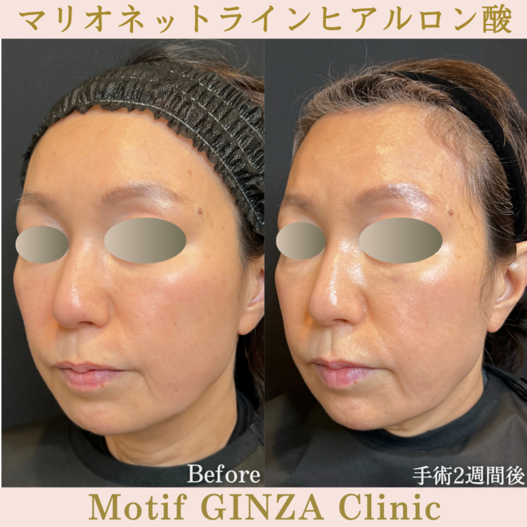 マリオネットラインヒアルロン酸（手術２週間）の写真2