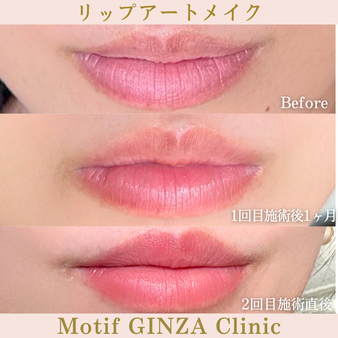 リップアートメイク（手術２ヶ月後）の写真