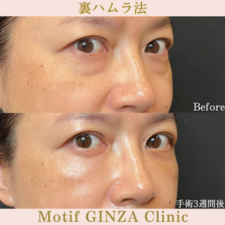 裏ハムラ法（手術３か月）の写真6
