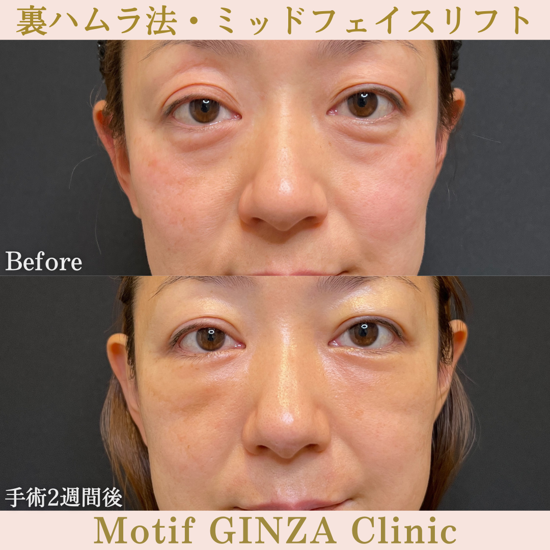 裏ハムラ法・ミッドフェイスリフト(手術6ヶ月)の写真5
