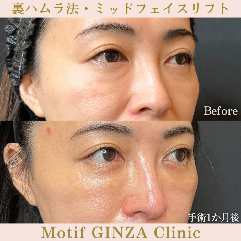 裏ハムラ法・ミッドフェイスリフト(手術3か月)の写真4