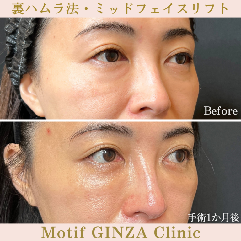 裏ハムラ法・ミッドフェイスリフト（手術３か月）の写真4