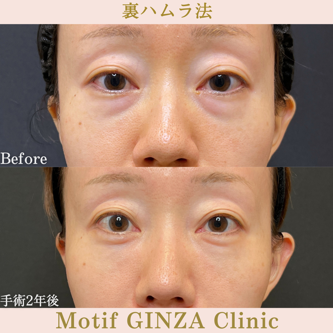 裏ハムラ法（手術２年）の写真