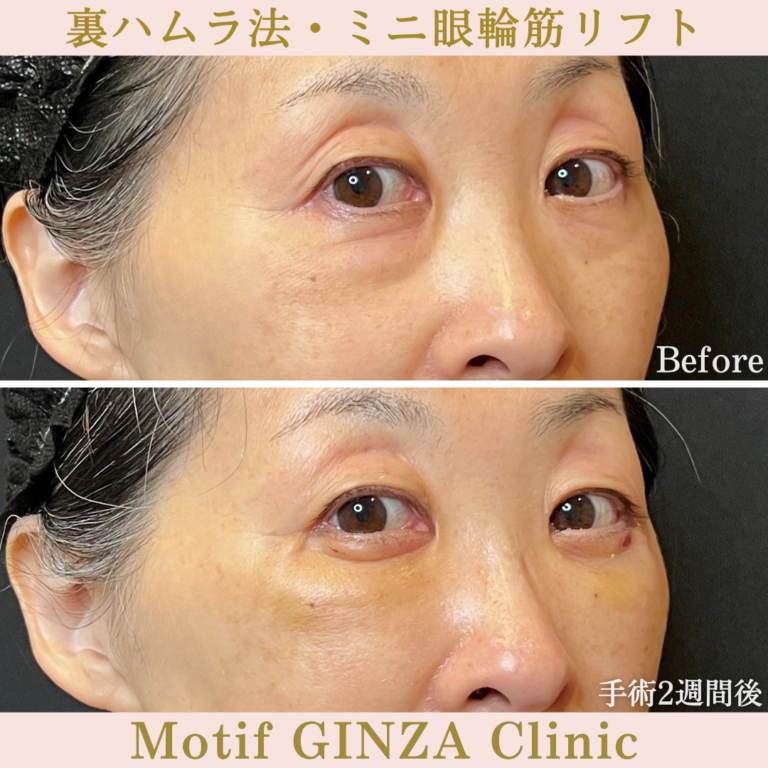 裏ハムラ法・ミニ眼輪筋リフト（手術1か月）の写真4