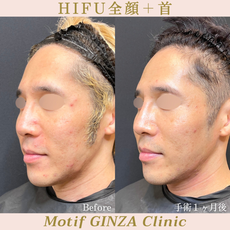 HIFU全顔＋首（手術１ヶ月）の写真2