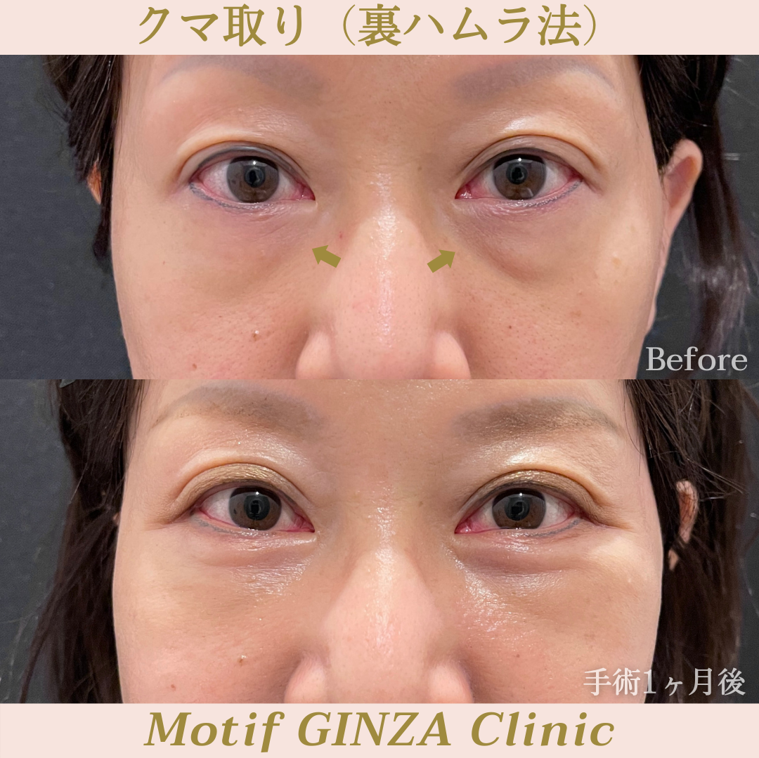 裏ハムラ法(手術3ヶ月)の写真2