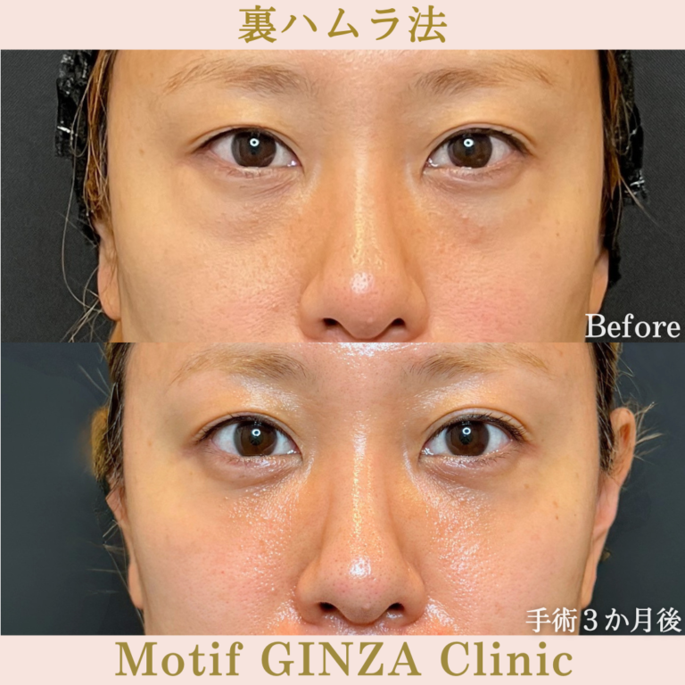 裏ハムラ法（手術3か月）