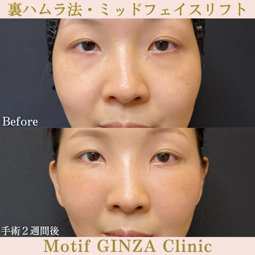 裏ハムラ法・ミッドフェイスリフト（手術３ヶ月）の写真5