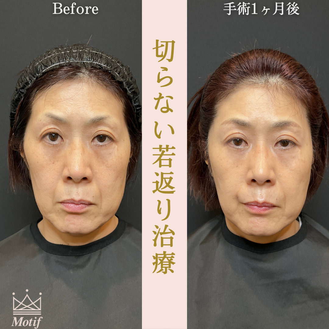 切らない若返り治療（手術１ヶ月）の写真2