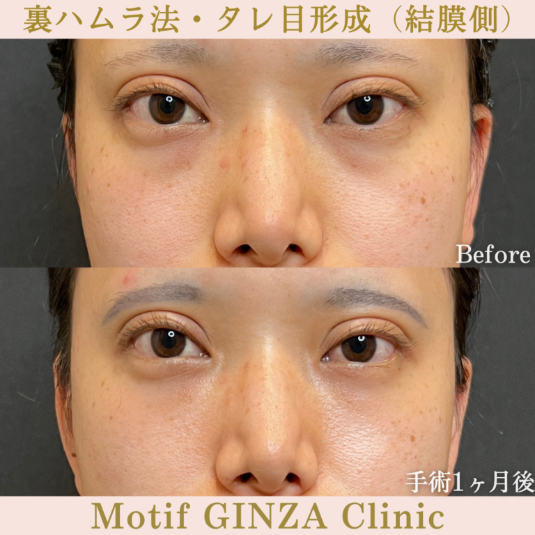 裏ハムラ法・タレ目形成（結膜側）（手術３か月）の写真3