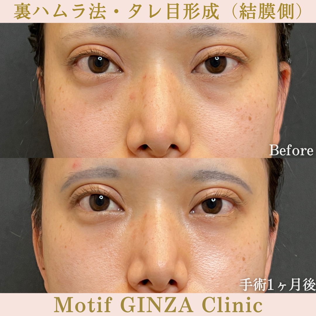 裏ハムラ法・タレ目形成(結膜側)(手術3か月)の写真3