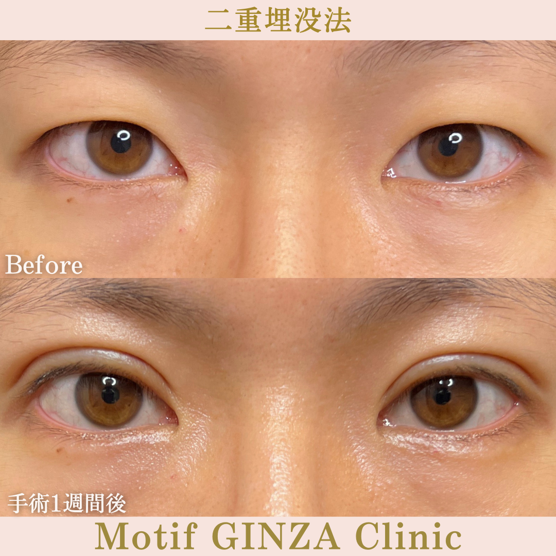 二重埋没法（手術１ヶ月）の写真2