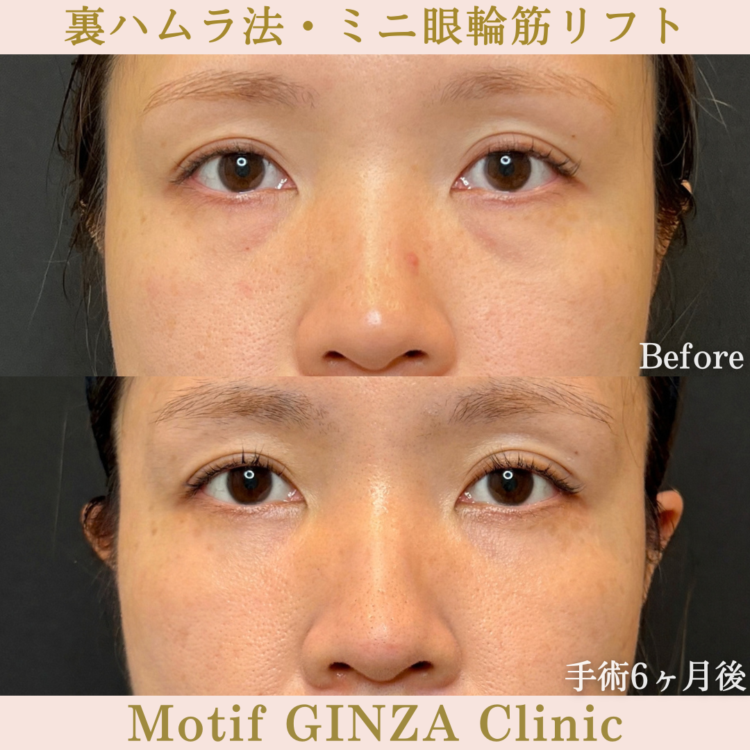 裏ハムラ法・ミニ眼輪筋リフト（手術6か月）の写真