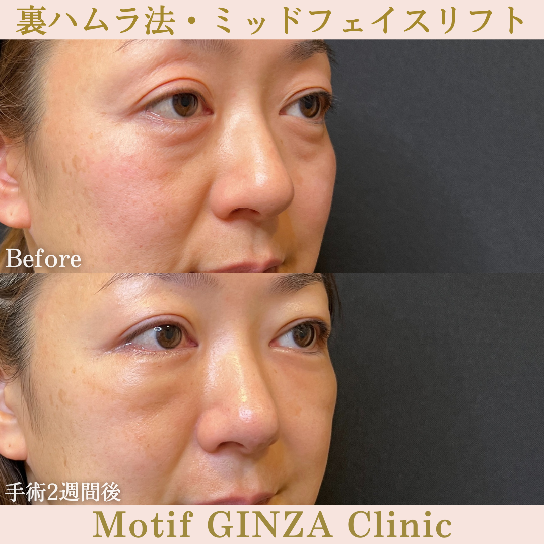 裏ハムラ法・ミッドフェイスリフト(手術6ヶ月)の写真6